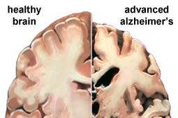 Alzheimer Research